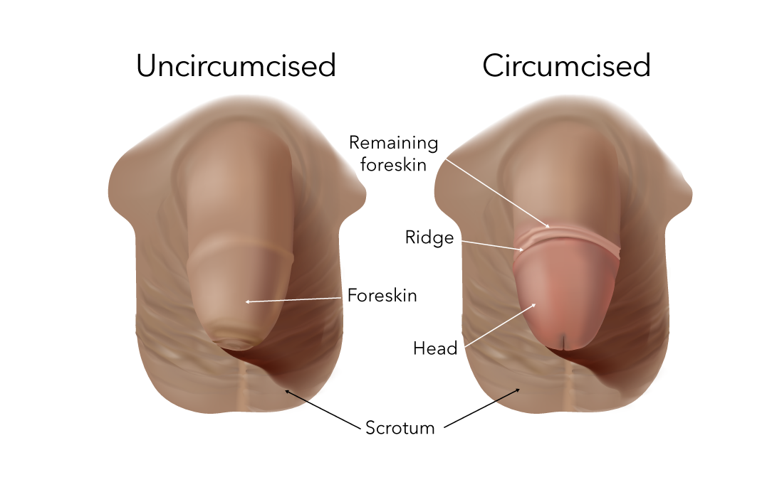 Newborn Circumcision TTG